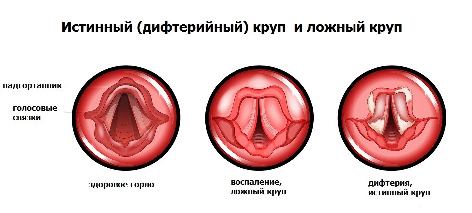 Вакцинопрофилактика дифтерии у детей..